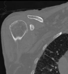 Effusion Shoulder With Degenerative Joint Disease (DJD) - CTisus CT Scan