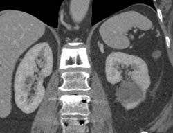 Spinal Fusion of Lower Spine - CTisus CT Scan