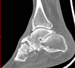 Fracture Tibia and Fusion Talus, Calcaneus - CTisus CT Scan