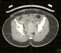 Grip Mapping for Gluteal Perforations - CTisus CT Scan