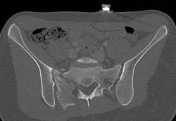 Sacral Fracture and Symphysis Fracture- Ring Fracture - CTisus CT Scan