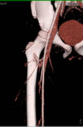 CTA Without Injury - CTisus CT Scan