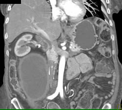 Psoas Abscess - CTisus CT Scan