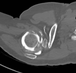 Rotator Cuff Tear on CT Arthrogram - CTisus CT Scan