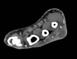 Abscess Hand in Multiple Perspectives - CTisus CT Scan