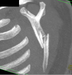 Scapular Fractures - CTisus CT Scan