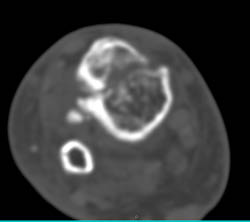 Tibial Fracture - CTisus CT Scan