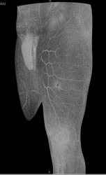 Bullet Wound Thigh Without Vascular Injury - CTisus CT Scan