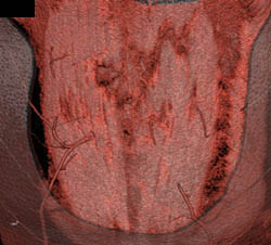 DIEP Flap Planning - CTisus CT Scan