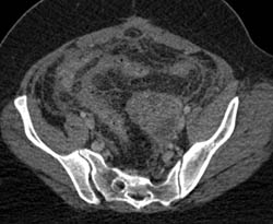 Pelvic Bleed - CTisus CT Scan