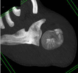 Humerus Fracture - CTisus CT Scan