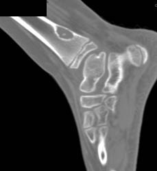 Non Ossifying Fibroma Tibia - CTisus CT Scan