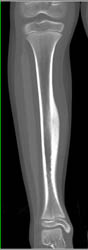 Osteoid Osteoma - CTisus CT Scan