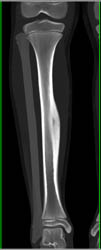 Osteoid Osteoma - CTisus CT Scan