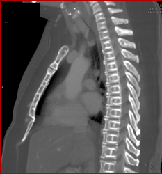 Osteoporosis- Incredible Case! - CTisus CT Scan