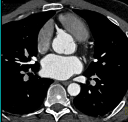 Post Coronary Artery Bypass Graft (CABG) Changes in Sternum - CTisus CT Scan