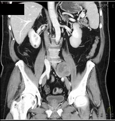 Neurofibroma Vs Schwannoma- Diagnosis Was Schwannoma - CTisus CT Scan