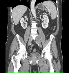 Neurofibroma Vs Schwannoma- Diagnosis Was Schwannoma - CTisus CT Scan