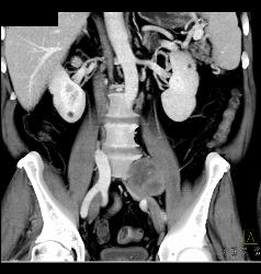 Neurofibroma Vs Schwannoma- Diagnosis Was Schwannoma - CTisus CT Scan
