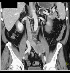 Neurofibroma Vs Schwannoma- Diagnosis Was Schwannoma - CTisus CT Scan