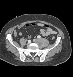 Neurofibroma Vs Schwannoma- Diagnosis Was Schwannoma - CTisus CT Scan