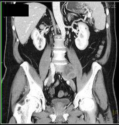 Neurofibroma Vs Schwannoma- Diagnosis Was Schwannoma - CTisus CT Scan