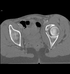 Acetabular Fracture With Pelvic Hematoma - CTisus CT Scan