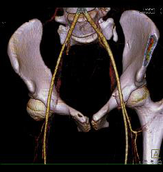 Acetabular Fracture With Pelvic Hematoma - CTisus CT Scan