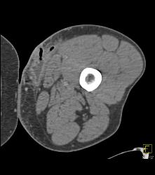 Abscess Thigh - CTisus CT Scan