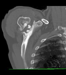 Antibiotics Put in Joint Space Following Prosthesis Removal - CTisus CT Scan