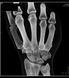Fracture Dislocation of Carpal/metacarpals, Especially the Base of the Metacarpal - CTisus CT Scan