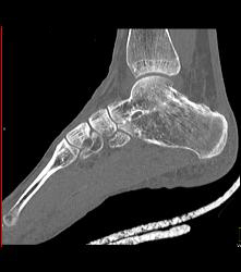 Fusion of Calcaneus and Talus - CTisus CT Scan