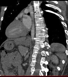 Hardware Abuts Descending Aorta - CTisus CT Scan