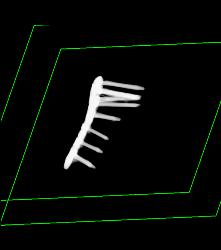 Hardware for Repair of Humerus Fracture - CTisus CT Scan