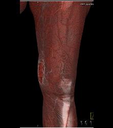 Ulcerations Thigh - CTisus CT Scan