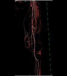 Ulcerations Thigh - CTisus CT Scan