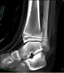Tibial Fracture - CTisus CT Scan