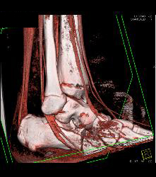 Tibial Fracture - CTisus CT Scan