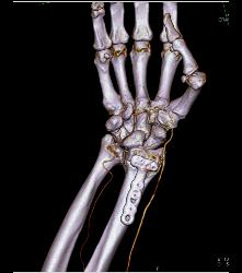 Hardware in Place in Distal Radius - CTisus CT Scan