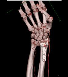 Hardware in Place in Distal Radius - CTisus CT Scan
