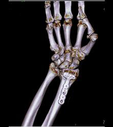 Hardware in Place in Distal Radius - CTisus CT Scan