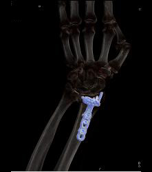 Hardware in Place in Distal Radius - CTisus CT Scan