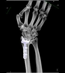 Hardware in Place in Distal Radius - CTisus CT Scan