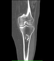 Osteochondroma - CTisus CT Scan