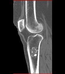 Osteochondroma - CTisus CT Scan