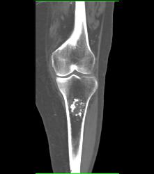 Osteochondroma - CTisus CT Scan