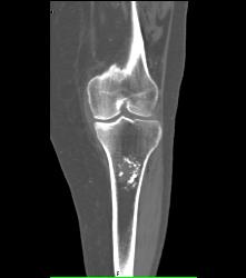Osteochondroma - CTisus CT Scan