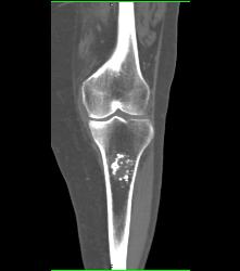 Osteochondroma - CTisus CT Scan