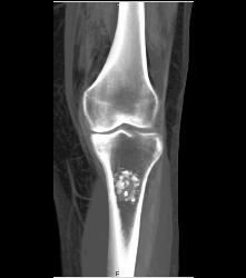 Osteochondroma - CTisus CT Scan