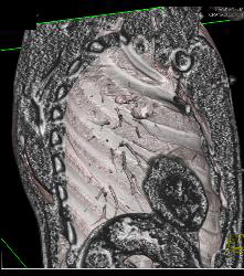 Rib Fracture - CTisus CT Scan